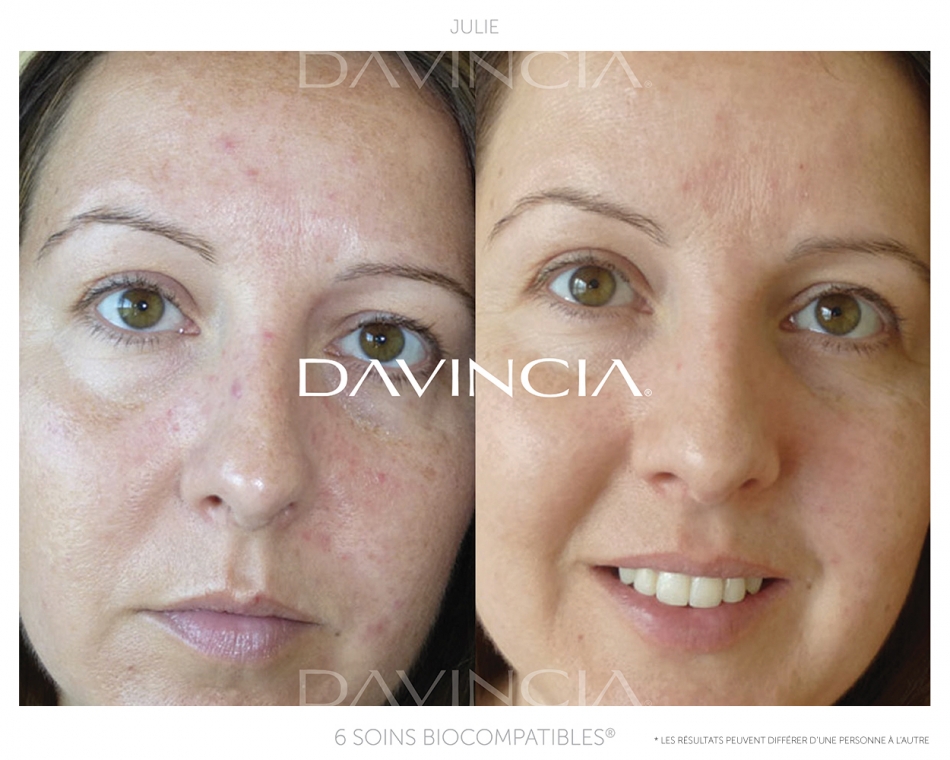 Peeling Davincia : Avant-après 1 soin