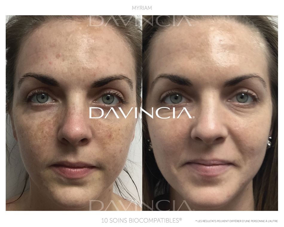 Peeling Davincia avant-apres 10 soins